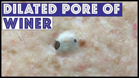  The patient is so excited to see. . Dr pimple popper dilated pore of winer